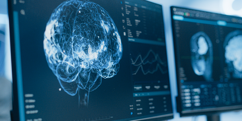 Neurologist reviewing detailed brain scans on hospital monitors.